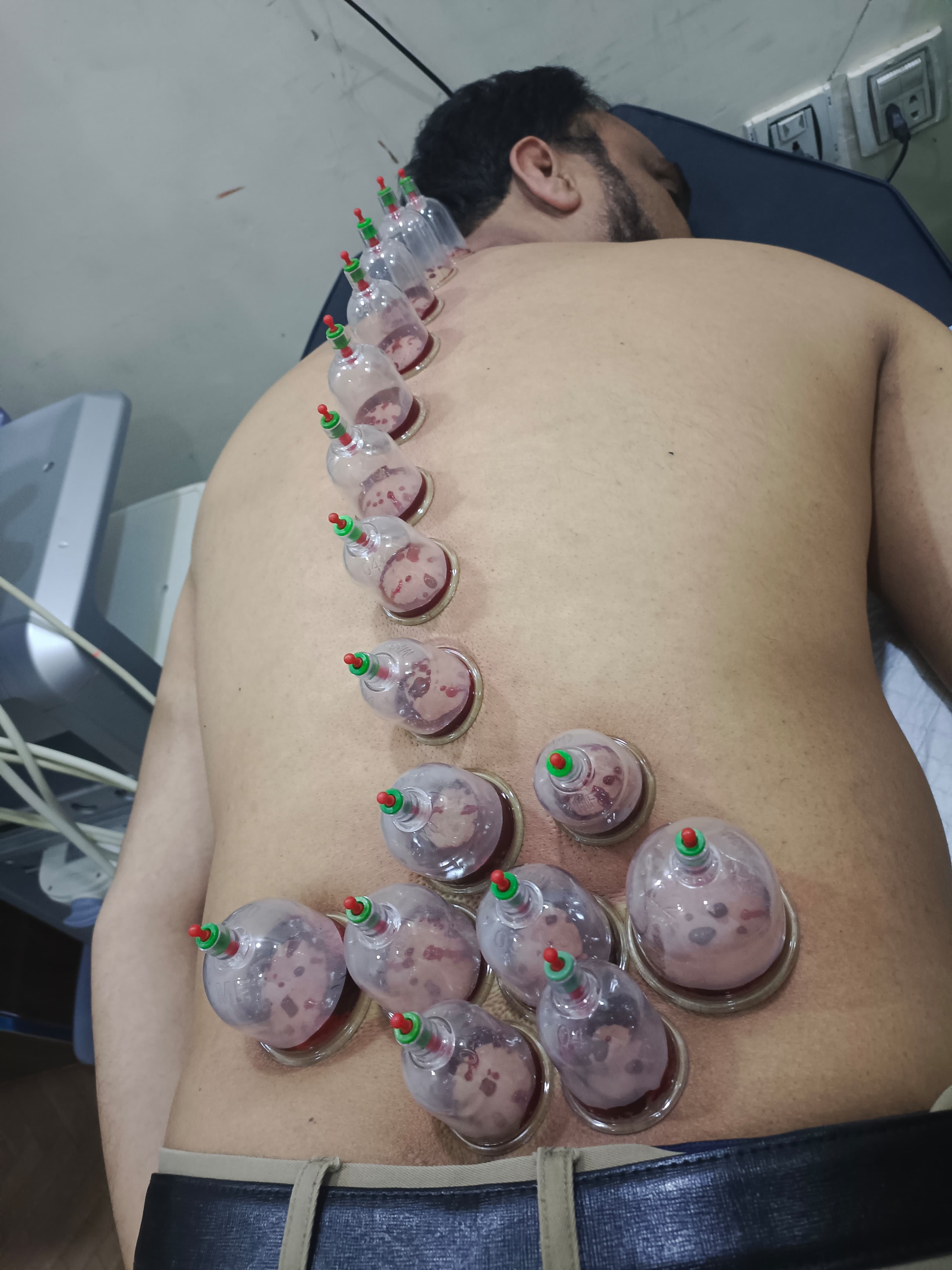 Full Body Hijama